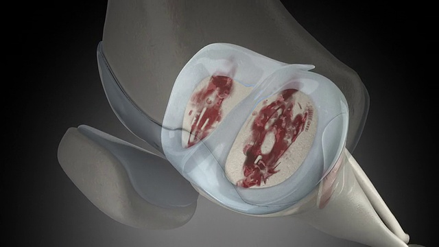 膝关节关节炎疼痛动画视频素材