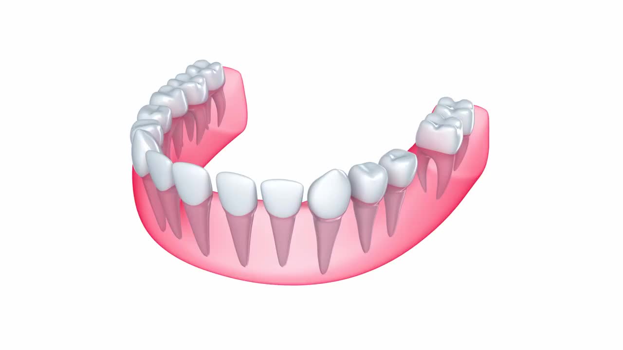 植入物嵌在牙龈中视频素材