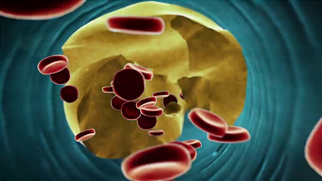 血管中的血块视频素材