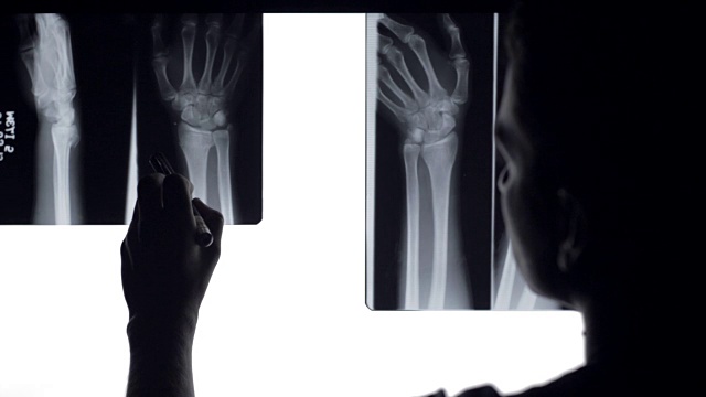 医生对骨折的骨头进行x光分析。视频素材