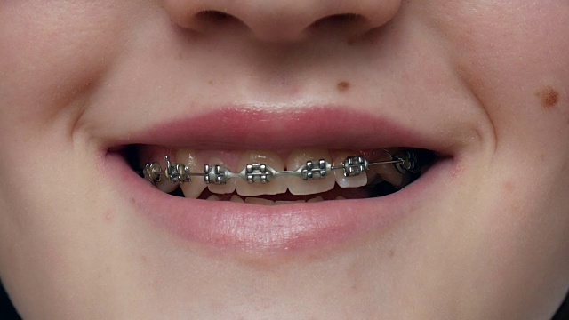近距离观察牙齿上的牙套。女孩露出牙套。视频下载