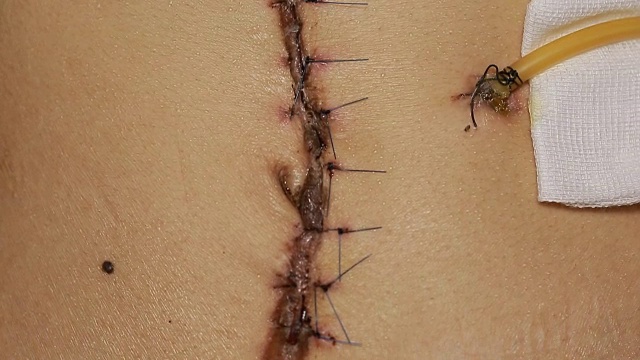 手术后留下的黑色纤维疤痕。在切除癌变痣的手术后缝合皮肤视频素材