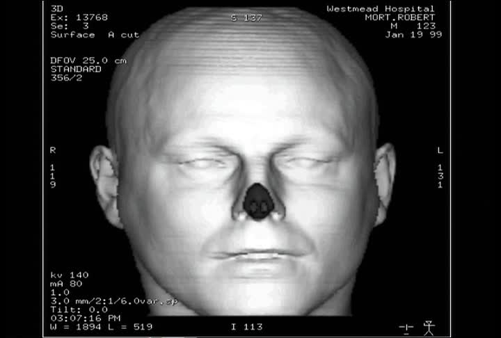 计算机生成的图像是人体头部分解后的医学图像视频下载