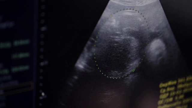 孕妇胎儿的超声波检查视频素材