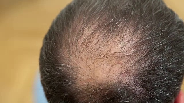一个男人摸着他秃顶的头的特写视频下载