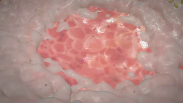 胃溃疡三维动画，4K超高清。视频素材