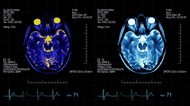 未来的医疗显示与动画mri大脑扫描和医疗数据在上面视频下载