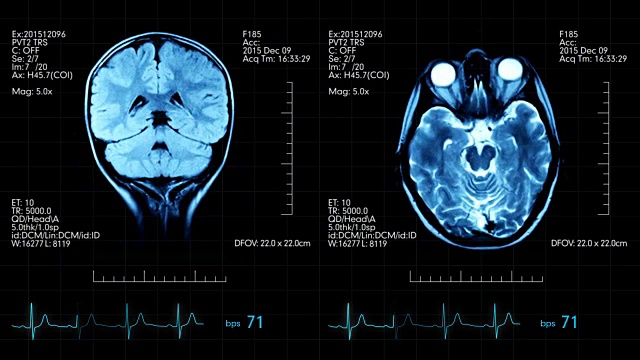 两个俯视图mri大脑扫描图像动画医学显示与心脏跳动和其他医疗数据视频下载