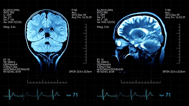 两个动画图像的mri大脑扫描在一个医疗显示心脏bps和其他数据视频下载