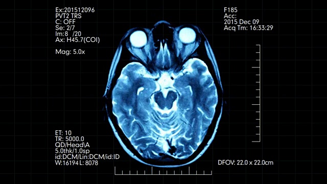 俯视图蓝绿色MRI脑部扫描显示动画数字和文字视频下载