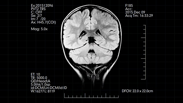 黑白MRI脑部扫描动画视频下载