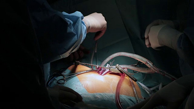 外科医生做心内直视手术。特写镜头视频下载