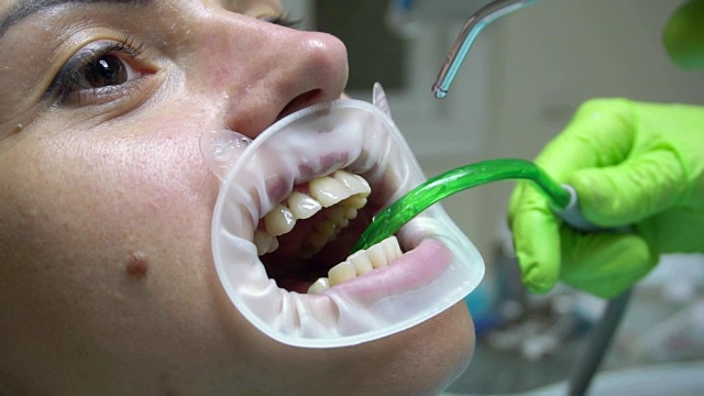 在牙科诊所里拿着扩张器的年轻女人。用水清洁牙齿。现代牙科诊所。牙科医生使用唾液喷射器或牙科泵排出唾液。在4 k拍摄视频素材