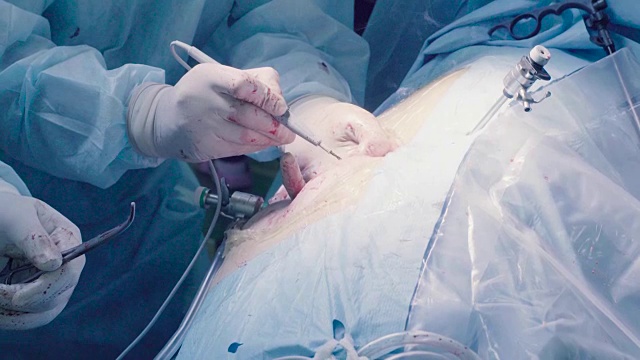 腹腔镜下的腹部手术视频下载