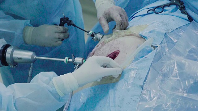 腹腔镜下的腹部手术视频下载