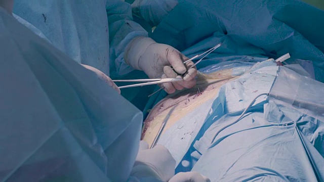 腹部手术腹部的外科手术缝合视频下载