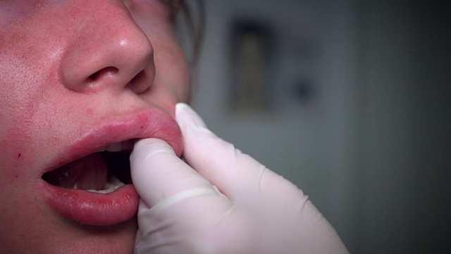 4K鼻唇填充手术的特写视频素材