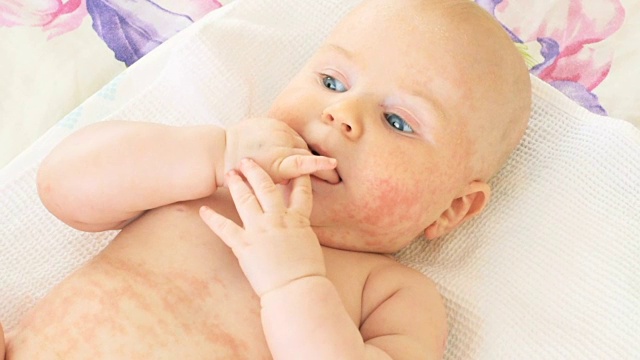 皮肤上有皮疹的婴儿视频下载