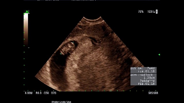 超音波显示同卵双胞胎的心脏在8周时跳动视频素材