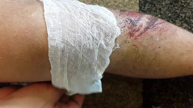 一个男人腿上的伤口。急救视频下载