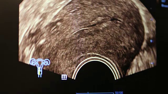 怀孕4 d超声视频素材