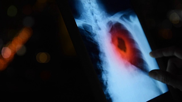 肺扫描视频下载