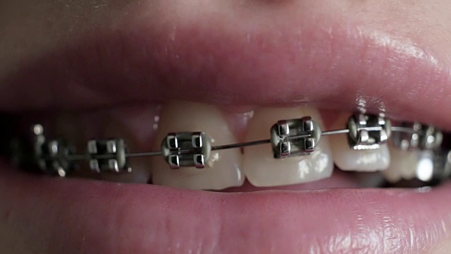 近距离观察牙齿上的牙套。女孩露出牙套。视频素材