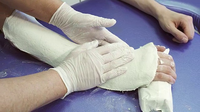 创伤科医生抚平病人手臂上的石膏绷带视频下载