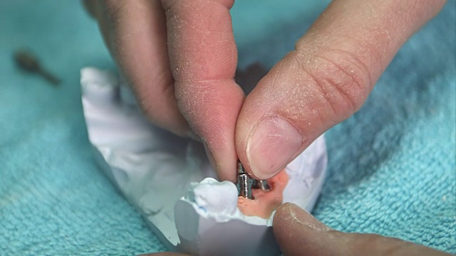 牙医展示植牙修复体模型视频下载
