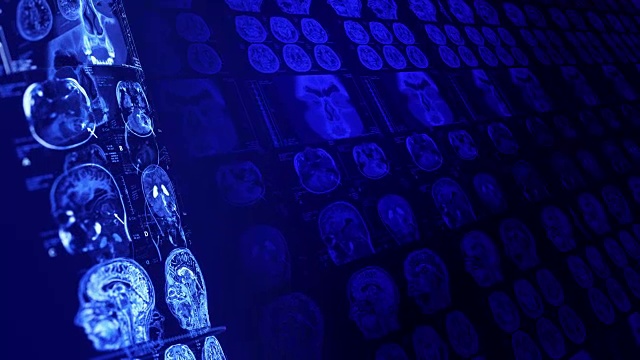 医学、临床背景。人脑的x射线计算机断层扫描。视频下载
