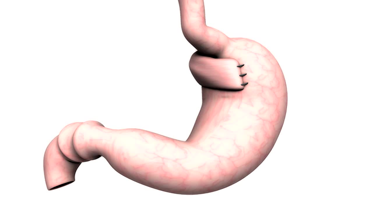 动画描绘了胃底在食管下端周围的手术折叠。当它旋转时，镜头会放大到腹部。视频下载
