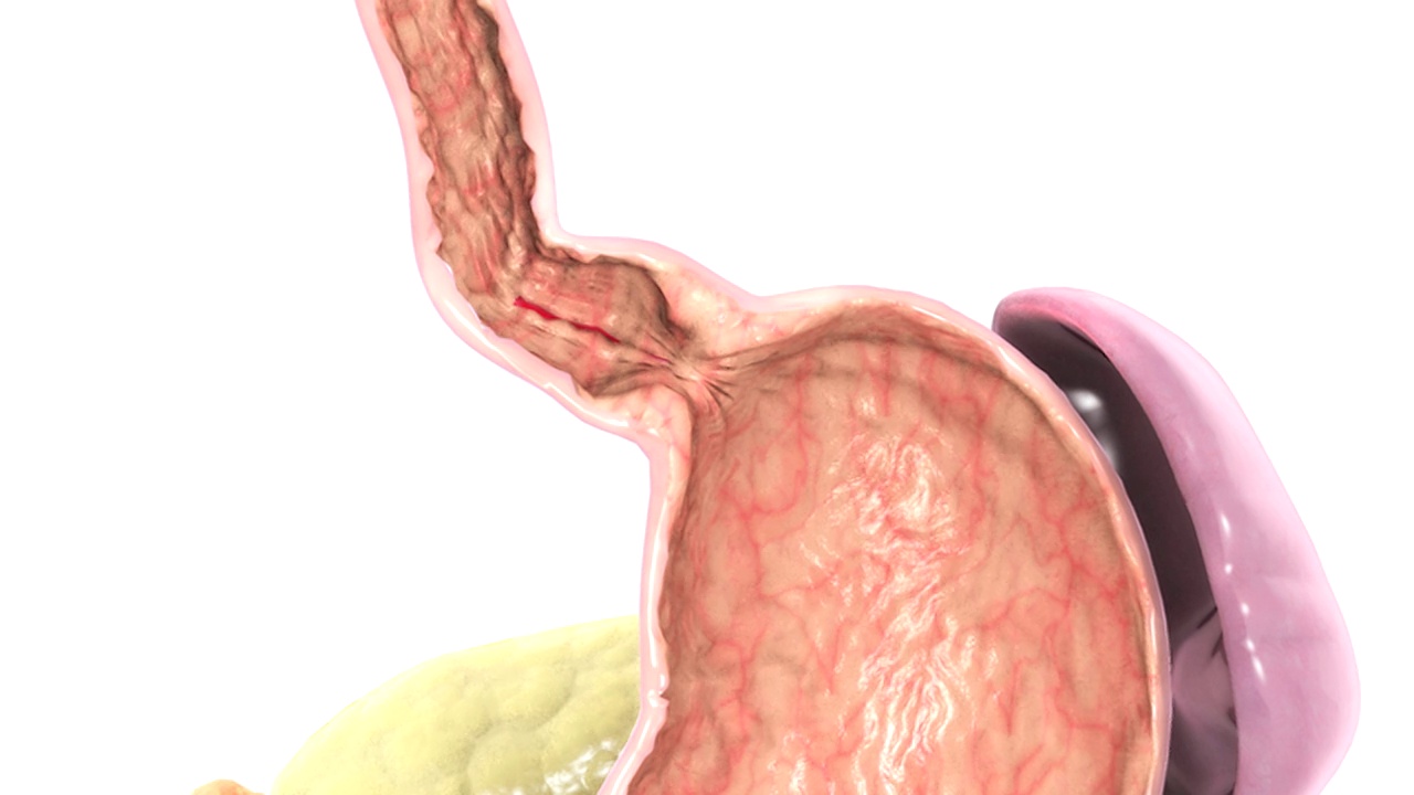食管下括约肌(LES)上方的食管下段撕裂。这种撕裂被称为马洛里-维斯撕裂。相机慢慢地向右平移并放大到LES。视频素材