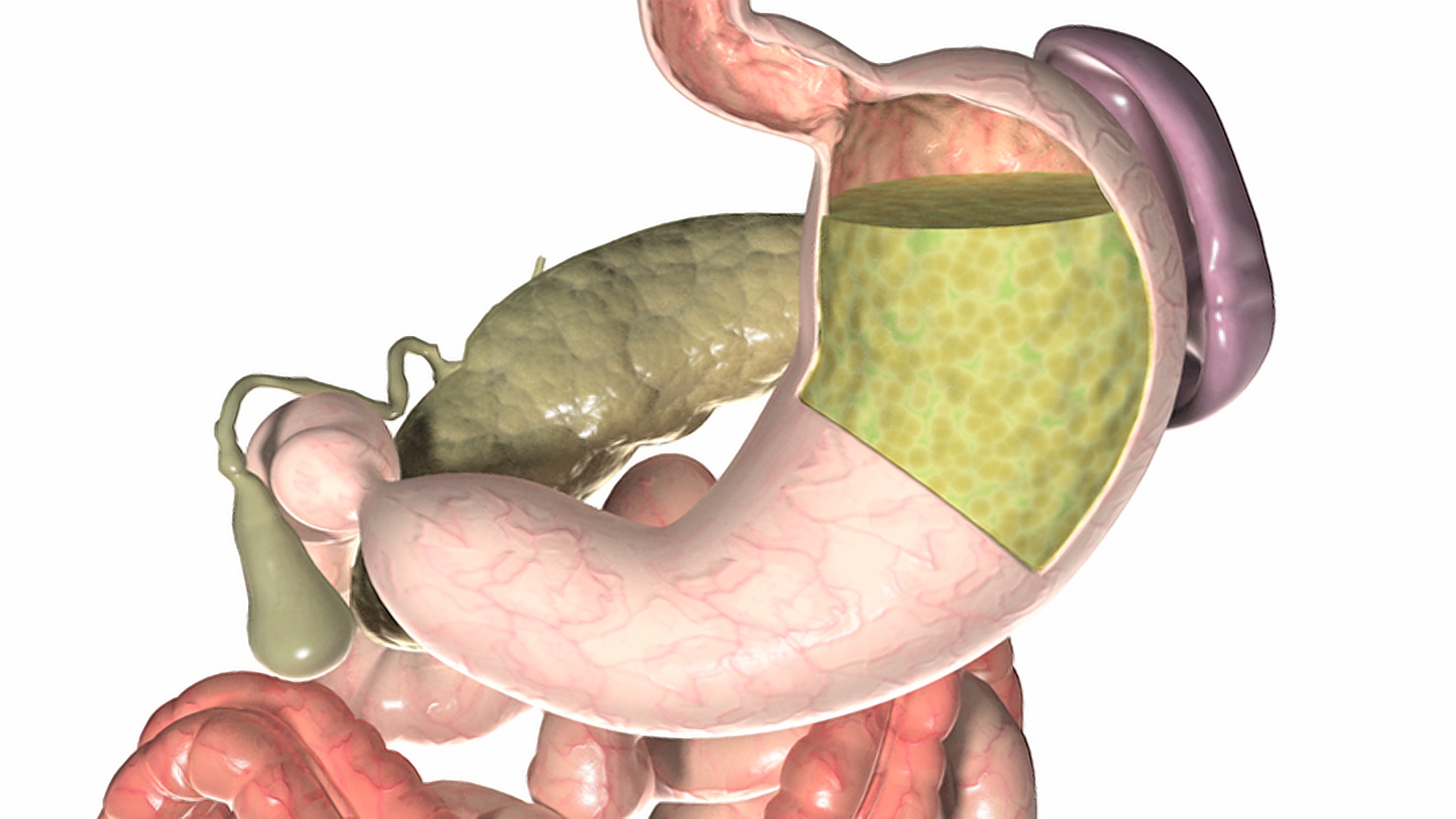 胃食管反流病或GERD的动画。随着镜头的放大，胃和食道分解成切面。胃液向上进入s区眼底视频素材