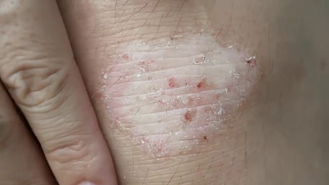 4K人抓挠皮肤，银屑病在膝盖显示发红，涂抹和干片状皮肤等干燥皮肤状况。视频下载