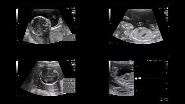 超声显示同卵双胞胎18周时心脏跳动视频素材