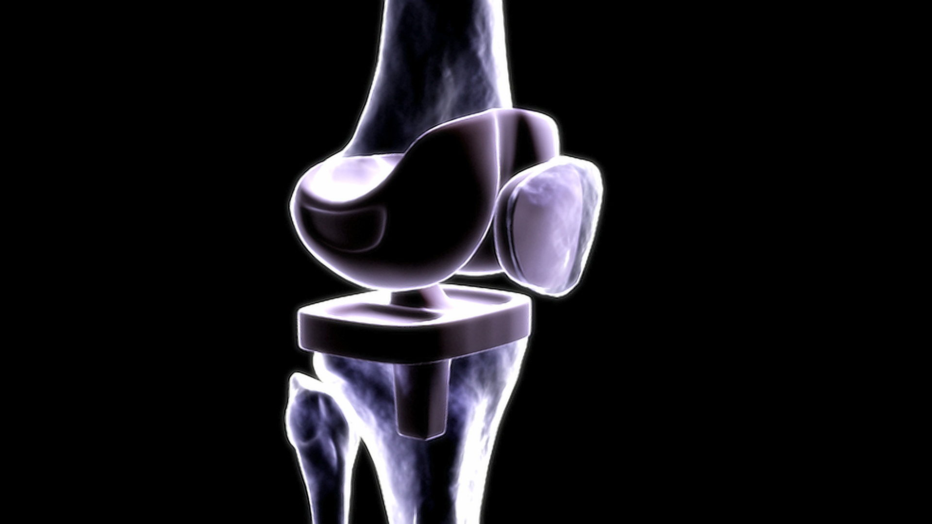 动画描绘一个替换的膝关节在x光风格。视频下载