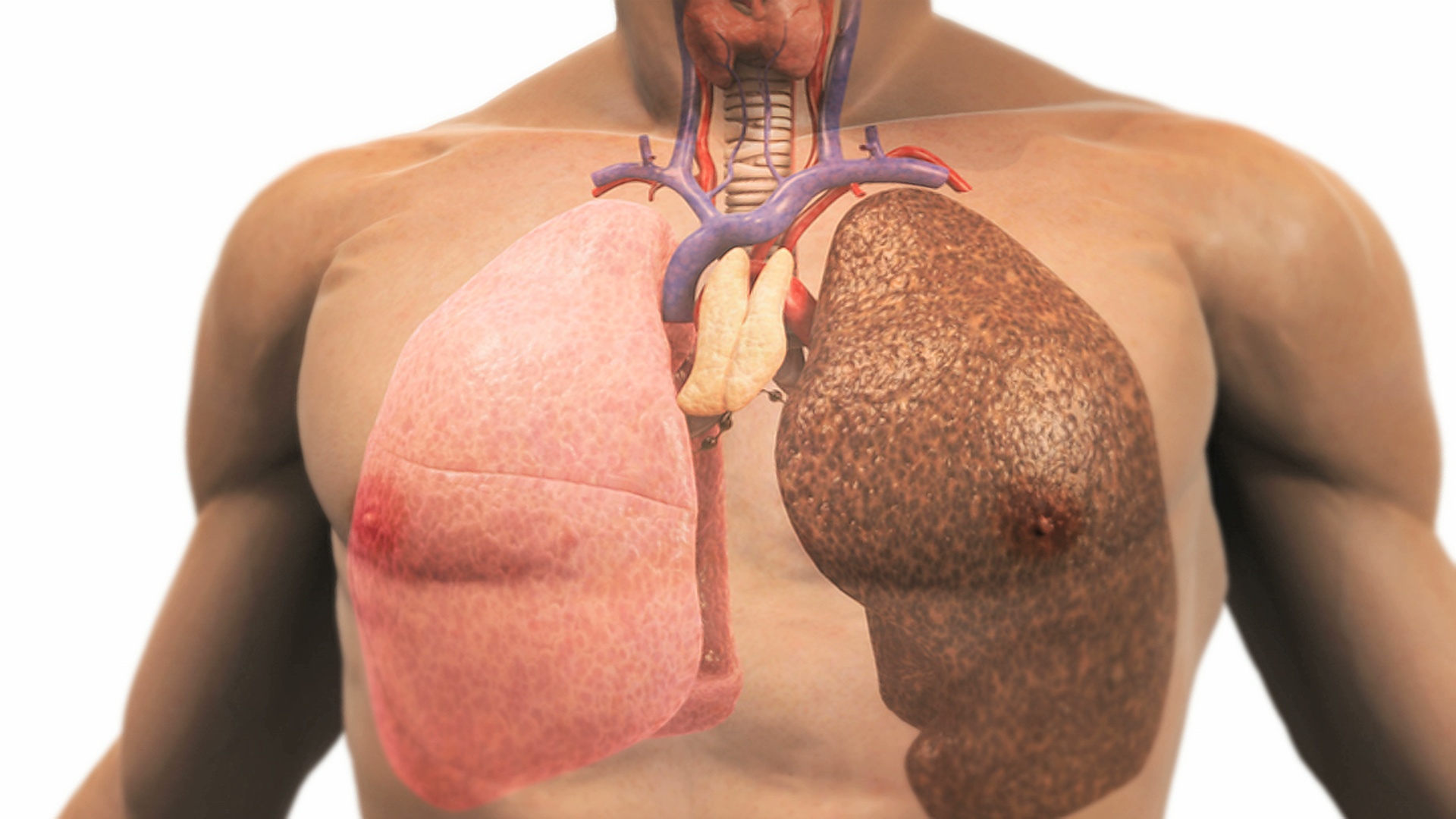 动画描绘了一个因吸烟而患病的肺。镜头拉近，尸体逐渐消失，露出肺部。视频素材