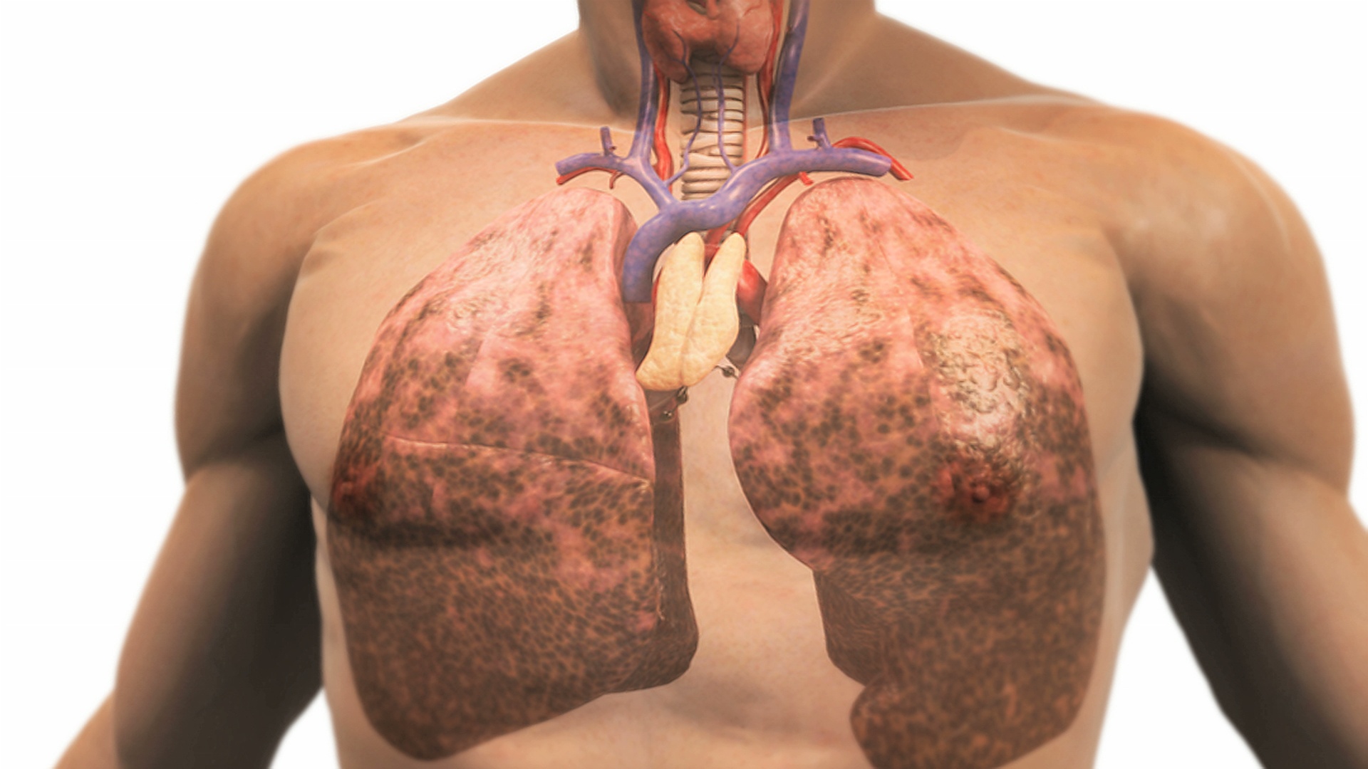 描绘因吸烟而患病的肺部的动画。镜头拉近，尸体逐渐消失，露出肺部。视频素材