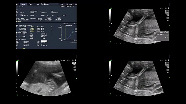 超声显示同卵双胞胎18周时心脏跳动视频素材