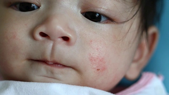 保健宝宝面部皮肤过敏性皮炎视频素材