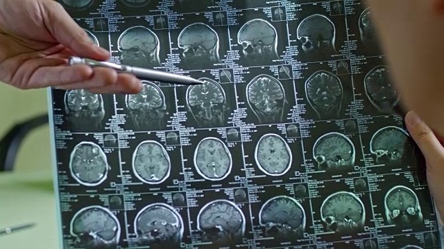 医生解释脑部CT扫描视频下载