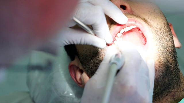 牙医在男人的牙齿上钻孔视频素材