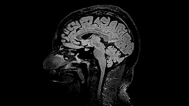MRI脑部扫描，对大脑进行磁共振成像，视频下载