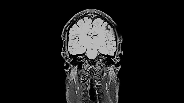 MRI脑部扫描，对大脑进行磁共振成像，视频素材