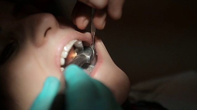 牙齿钻孔和准备清除蛀牙，关闭视频素材
