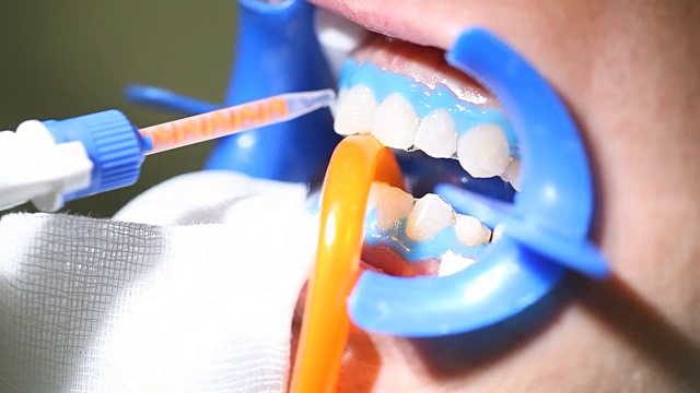 牙医的手让牙齿变白视频下载
