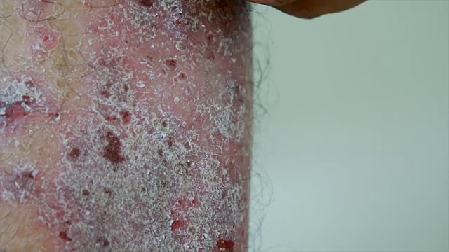 皮肤炎的牛皮癣患者瘙痒的抓伤视频素材