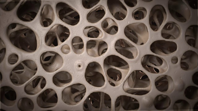 三维CG动画骨质疏松骨微观结构视频素材