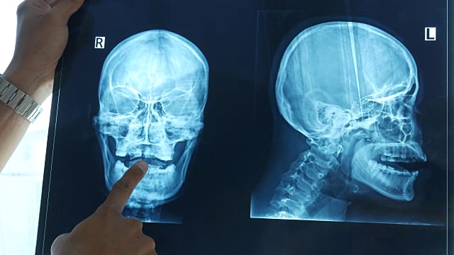 医生检查颅骨，用x光片扫描视频下载