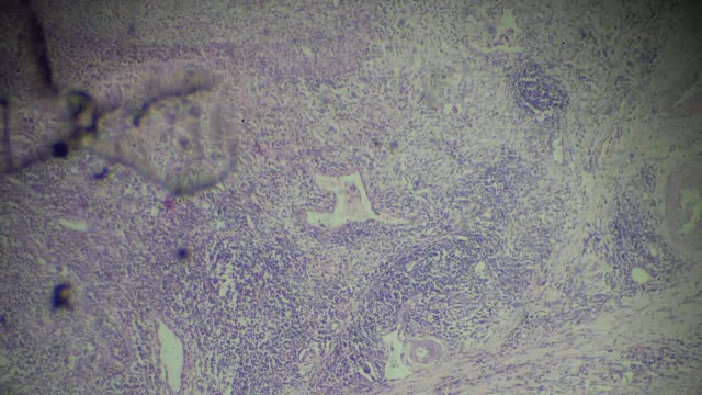 膀胱移行细胞癌不同部位显微镜变焦观察视频素材